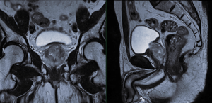 prostate mri scan