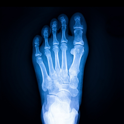 X-ray of foot showing bone structure