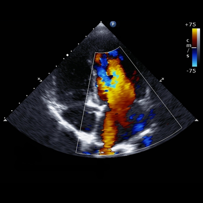 Ultrasound echocardiography showing function
